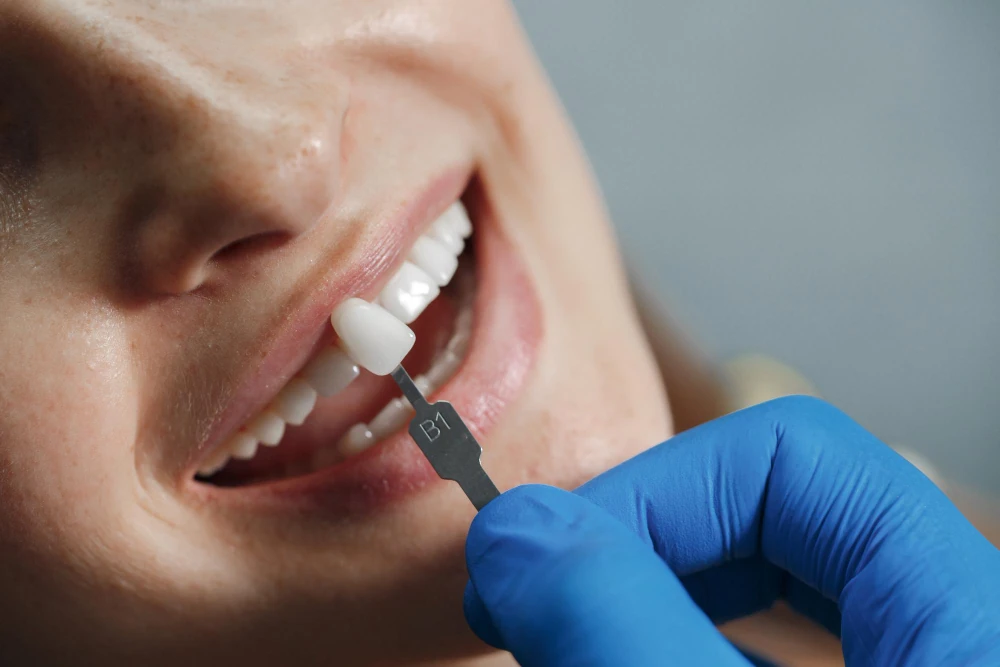 Que son y para qué sirven las coronas dentales
