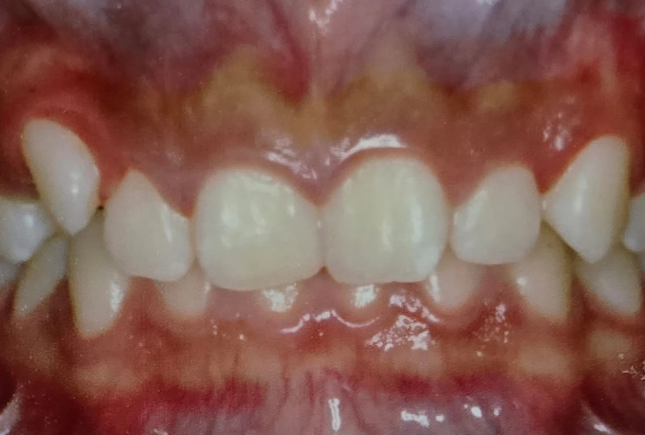 Antes